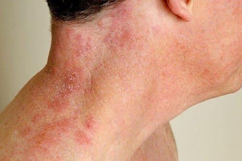 Lý do người lớn tuổi dễ mắc bệnh zona thần kinh