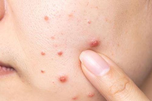 Vì sao phụ nữ mãn kinh vẫn bị mụn?