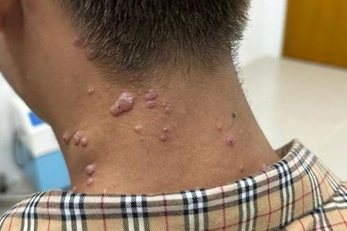 Đồng Nai phát hiện ca đậu mùa khỉ chưa rõ nguồn lây