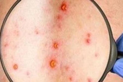 Đồng Nai ghi nhận ca mắc đậu mùa khỉ chưa rõ nguồn lây