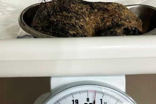 Nửa cân tóc trong dạ dày bé gái 6 tuổi