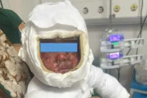 Cấp cứu thành công bé trai 9 tháng tuổi bỏng nặng do nước sôi