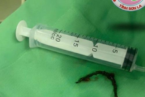 Cấp cứu thành công bệnh nhân 48 tuổi mắc dị vật thực quản dài 12 cm
