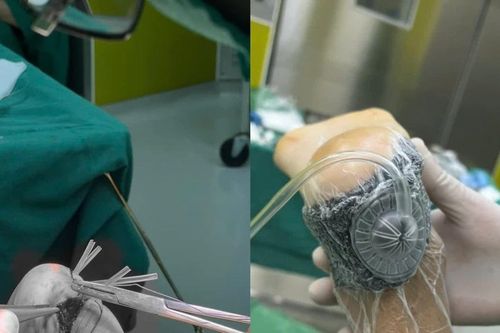 Cứu giữ gót chân dập nát cho người bệnh đa chấn thương