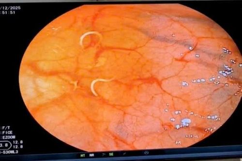 Rối loạn tiêu hóa kéo dài, bệnh nhân bất ngờ phát hiện nhiễm giun tóc nặng