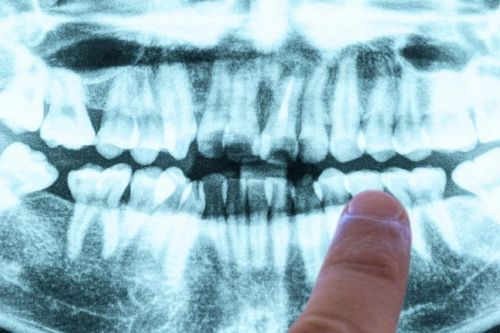 Bất ngờ: Nguyên nhân gây Alzheimer có thể bắt nguồn… ngay trong miệng bạn