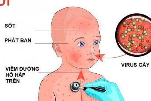Tự ý dùng kháng sinh khi mắc sởi có thể làm bệnh nặng hơn
