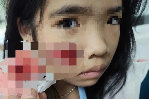 Đang chơi tại sân nhà, bé gái bị khỉ hoang tấn công gây thương tích ở mặt và đầu
