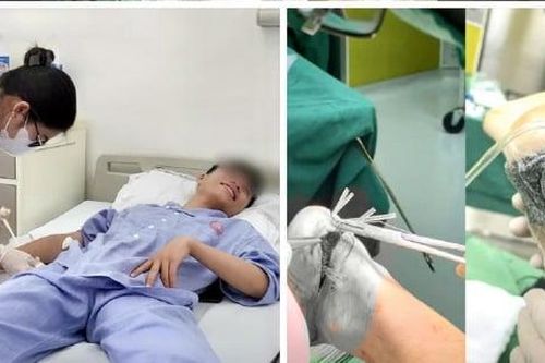 Phẫu thuật thành công tổn thương 'gót chân Honda' cho bệnh nhân bị tai nạn lao động