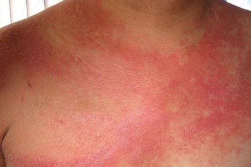 Biến chứng nguy hiểm của lupus ban đỏ hệ thống