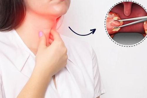 Lợi ích và rủi ro khi cắt amidan