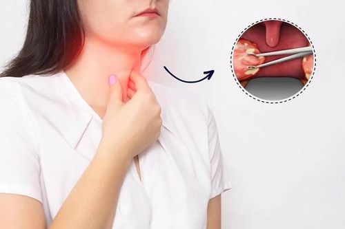 Bác sĩ chỉ ra lợi ích và rủi ro khi cắt amidan