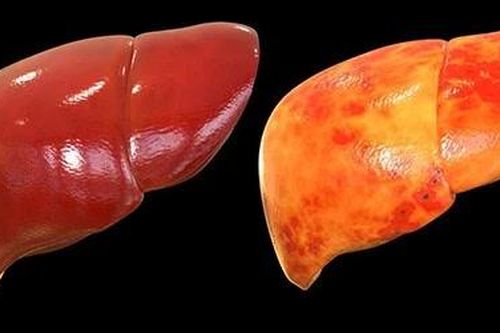 Khoảng 10-20% người gầy mắc gan nhiễm mỡ