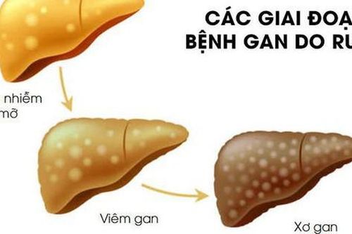 Thói quen âm thầm hủy hoại lá gan mà đàn ông Việt hay mắc phải