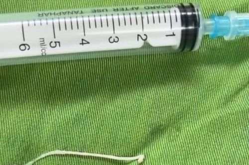 Phát hiện ổ sán ký sinh ở một nơi không ngờ trong cơ thể