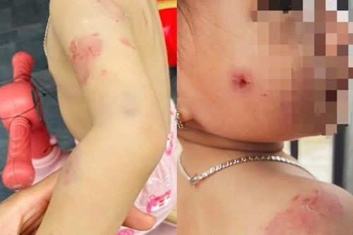 Phụ huynh bức xúc khi con gái hơn 2 tuổi chi chít vết cắn trên người sau giờ học