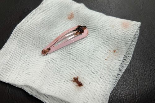 Gắp kẹp tóc dài 7cm khỏi dạ dày bé gái 6 tuổi