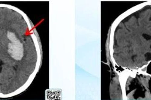 Hành trình cấp cứu xuất huyết não từ hôn mê đến hồi sinh