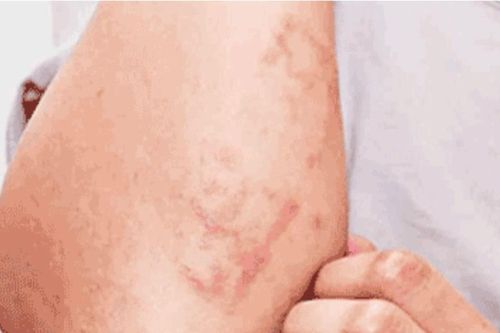Số ca nhiễm giun đũa chó mèo tại Khánh Hòa tăng cao trong hơn 1 tháng qua