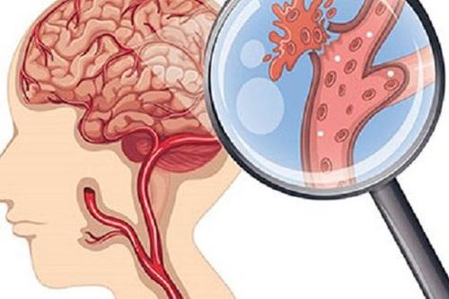 Các dấu hiệu đột quỵ dễ bị bỏ qua khi trời lạnh