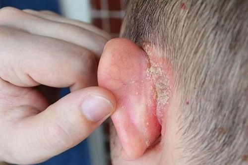 Vành tai đỏ, ngứa, khô da và bong tróc cảnh giác với bệnh chàm tai