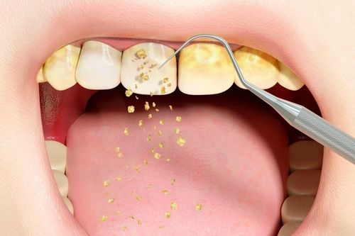 5 nguyên nhân gây hôi miệng