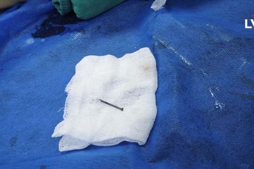 Căng mình giành lại sự sống cho bệnh nhi 8 tuổi nuốt phải đinh
