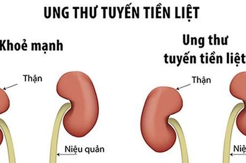 Ung thư tuyến tiền liệt gia tăng, nhiều ca phát hiện ở giai đoạn muộn