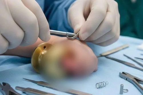 Bác sĩ làm 'thợ sửa khóa' cứu ngón tay bé trai 5 tuổi