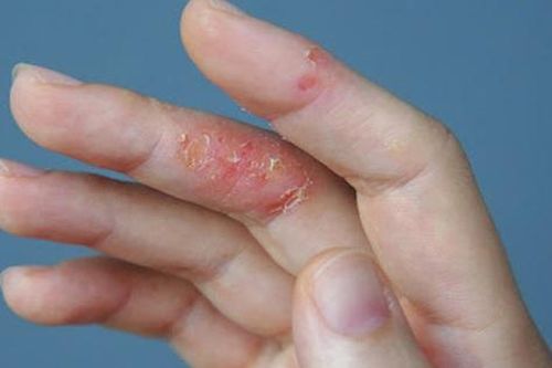 6 lưu ý quan trọng cho người bị viêm da cơ địa khi thời tiết khô hanh