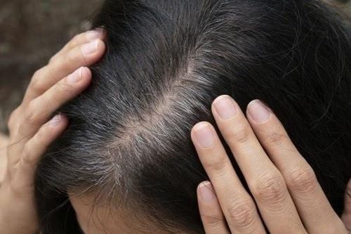 Tóc bạc nhiều là dấu hiệu ung thư: Bác sĩ nói gì?