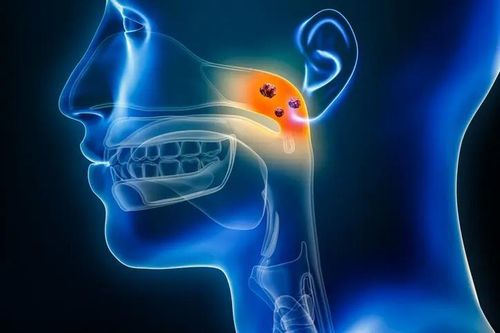 5 'thủ phạm' âm thầm dẫn tới ung thư vòm họng