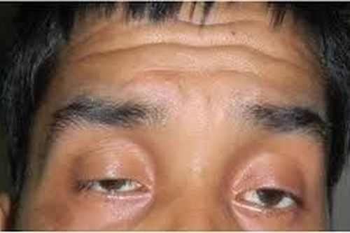 Bác sĩ Bệnh viện Nhân dân 115 điều trị ca bệnh rất hiếm gặp