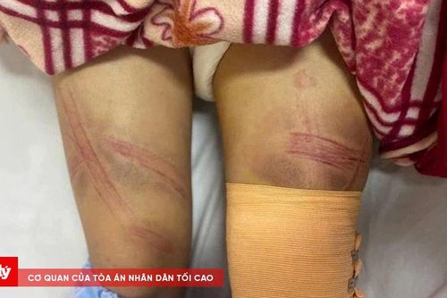 Xác minh vụ nữ sinh lớp 7 bị bố đánh phải nhập viện