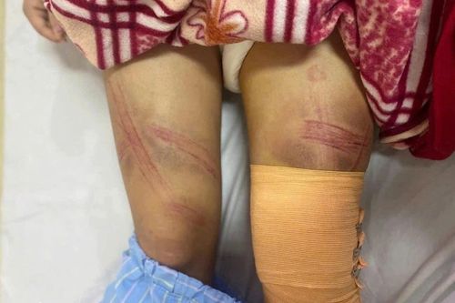 Nữ sinh lớp 7 ở Nghệ An nhập viện nghi do bị bố bạo hành
