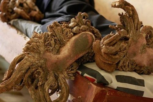 Bí ẩn kỳ lạ của căn bệnh 'người cây'