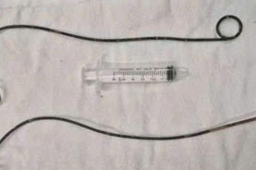 Phẫu thuật lấy 2 ống thông JJ bị bệnh nhân 'bỏ quên' trong người hơn 10 năm