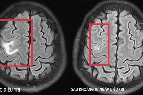 Cơn co giật bất thường hé lộ 'vị khách lạ' ký sinh trong não