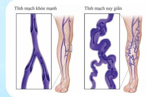 Thuốc và phương pháp điều trị suy tĩnh mạch chi dưới mạn tính