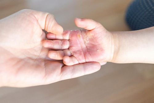 Tai nạn bỏng ở trẻ em, hiểm họa từ những phút lơ là