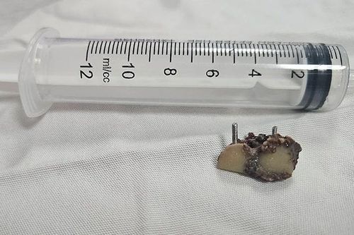 'Bỏ quên' răng giả hơn 20 năm trong phổi