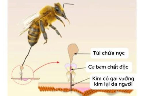 Nhanh chóng lấy ngòi kim đúng cách, giảm biến chứng do ong đốt