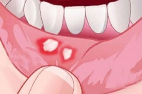 Mùa đông hay bị loét miệng, đừng chủ quan vì có thể là dấu hiệu của bệnh nguy hiểm
