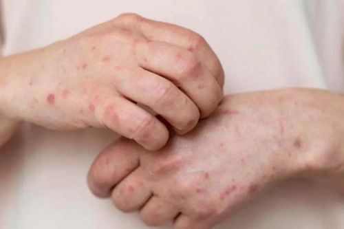 Dấu hiệu cảnh báo ung thư đại tràng xuất hiện trên da