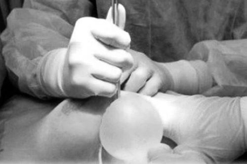 Biến dạng sau khi tiêm filler nâng ngực