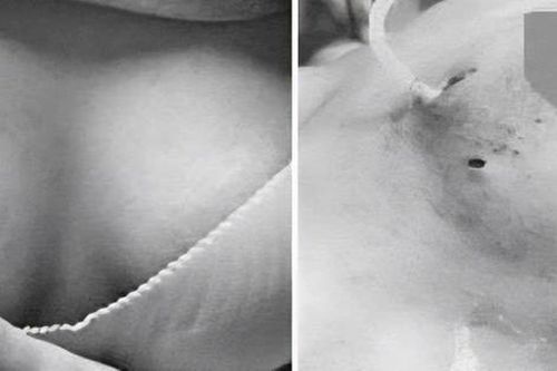 Người phụ nữ 30 tuổi bị nhiễm trùng ngực sau khi tiêm filler tại cơ sở thẩm mỹ 'chui'