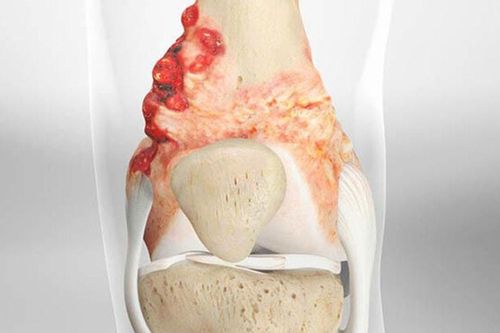 Ung thư xương: Bệnh hiếm gặp, di căn nhanh và khó phát hiện sớm