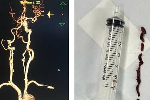 Cứu cụ bà 75 tuổi đột quỵ nhồi máu não thoát lằn ranh sinh tử
