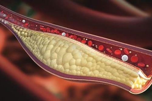 Máu nhiễm mỡ nguy hiểm thế nào?