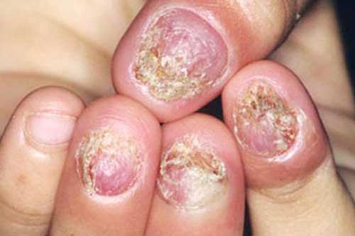 Điều trị hiệu quả nấm móng tay, móng chân